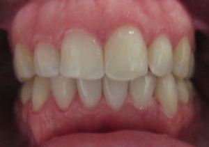 Patient's teeth after Invisalign