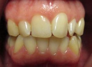 Patient's teeth before Invisalign
