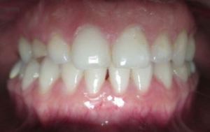 Patient's teeth after Invisalign