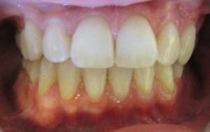 Patient's teeth after Invisalign