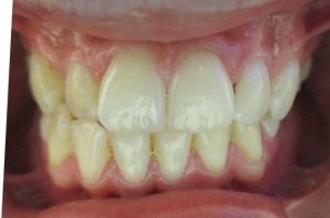 Patient's teeth before Invisalign