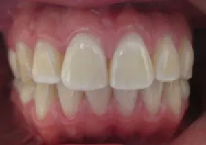 Patient's teeth after Invisalign