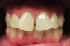 Patient's teeth before Invisalign
