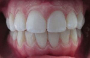 Patient's teeth after Invisalign