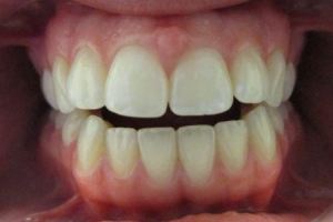Patient's teeth before Invisalign