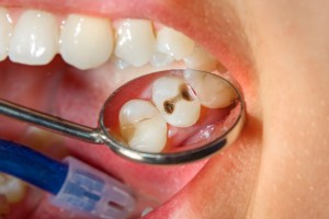 Cavity in a patient's mouth