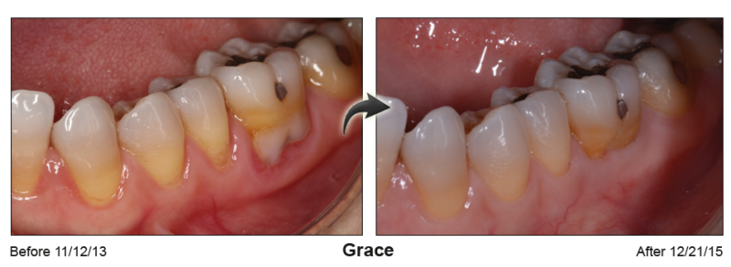 Patient's mouth before and after Pinhole Gum Rejuvenation™