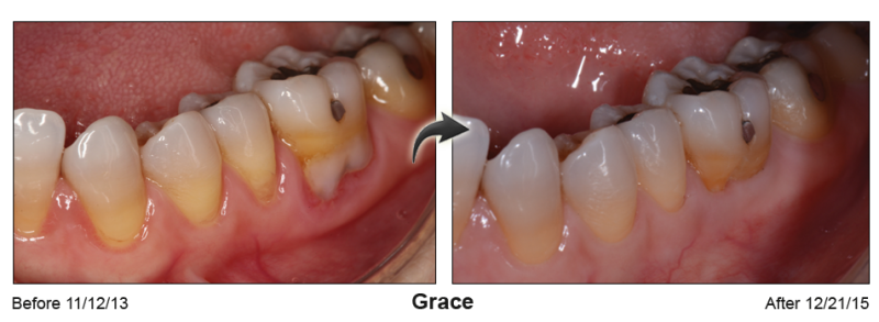 Patient's mouth before and after Pinhole Gum Rejuvenation™