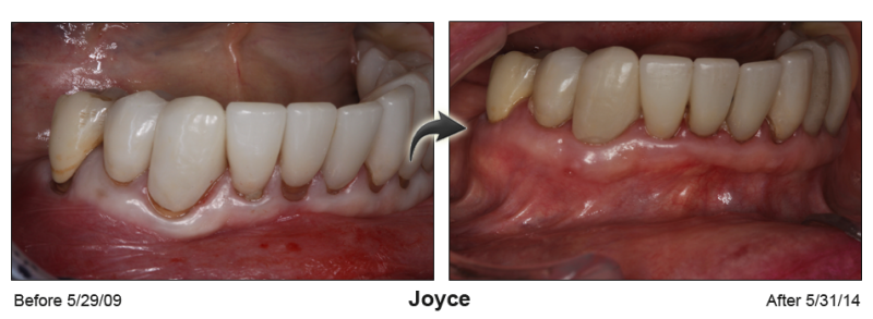 Patient's mouth before and after Pinhole Gum Rejuvenation™
