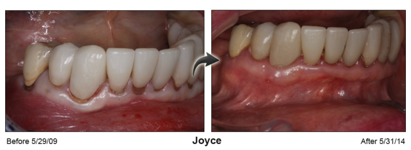 Patient's mouth before and after Pinhole Gum Rejuvenation™