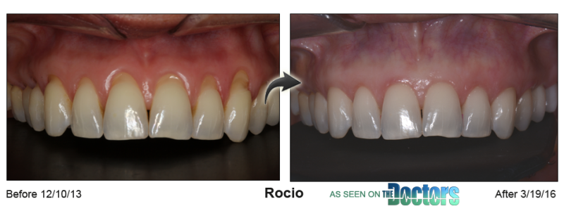 Patient's mouth before and after Pinhole Gum Rejuvenation™