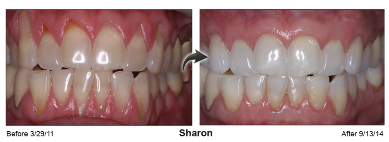 Patient's mouth before and after Pinhole Gum Rejuvenation™