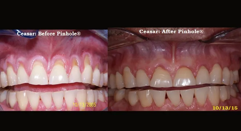 Patient's mouth before and after Pinhole Gum Rejuvenation™