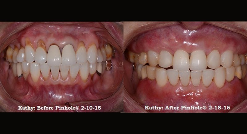 Patient's mouth before and after Pinhole Gum Rejuvenation™