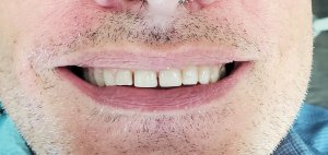After - Dental Bonding