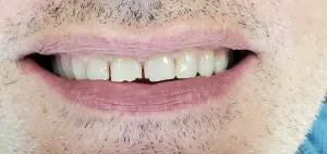 Before Dental Bonding - chipped front teeth