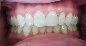 After - Dental Bonding