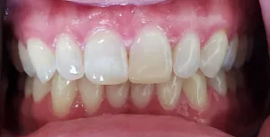 Before Dental Bonding- Discolored old composite