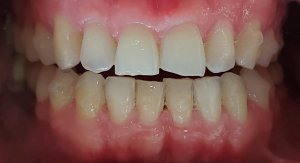 Before - chipped front teeth