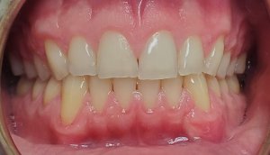 After - Gum tissue graft on upper right and lower left canines