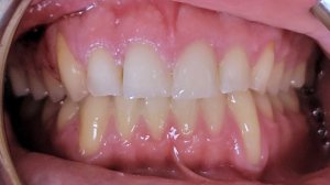 Before - Severe recession on upper right and lower left canines