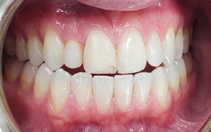 Before - Chipped front tooth