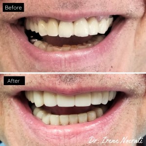 porcelain veneers before and after