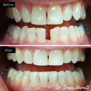 Before and after comparison of teeth showing improved alignment and whitening.