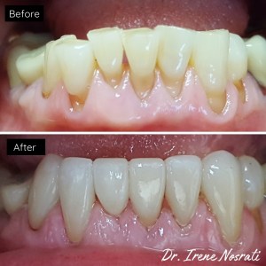Before and after comparison of teeth showing significant whitening and restoration.