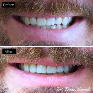 porcelain veneers before and after