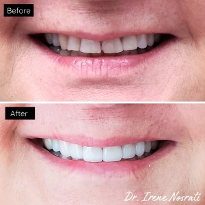 Dental Veneers