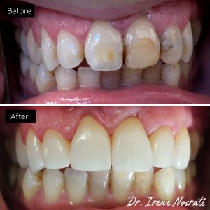 Veneers