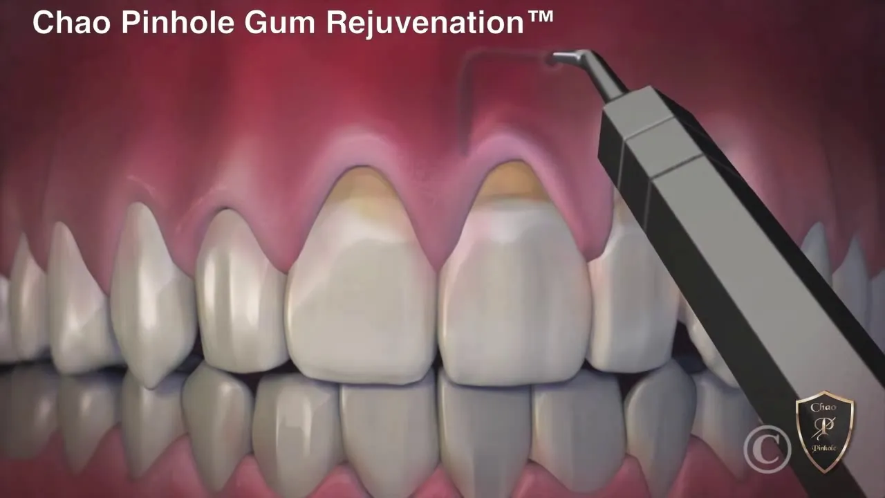 Pinhole Gum Rejuvenation vs. Conventional Gum Grafting Video Thumbnail